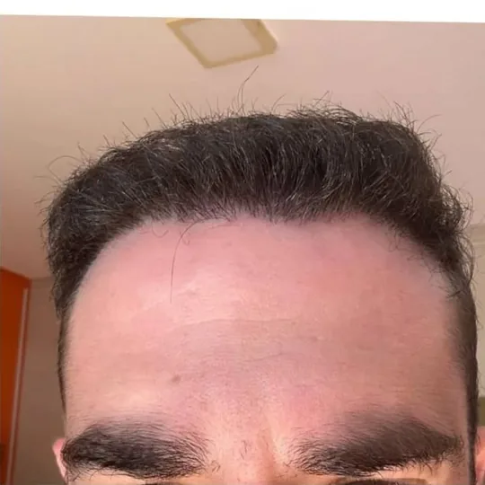 Região frontal depois do transplante, com a linha do cabelo preenchida